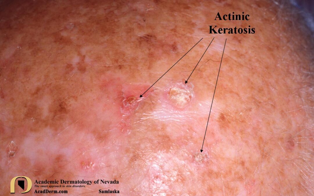 Actinic Keratosis:  What is it?