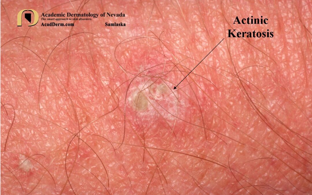 Actinic Keratosis:  Why does Dr. Samlaska freeze so much…
