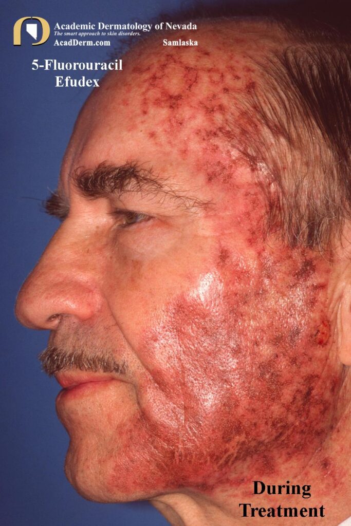 AKs5Samlaska - Academic Dermatology of Nevada