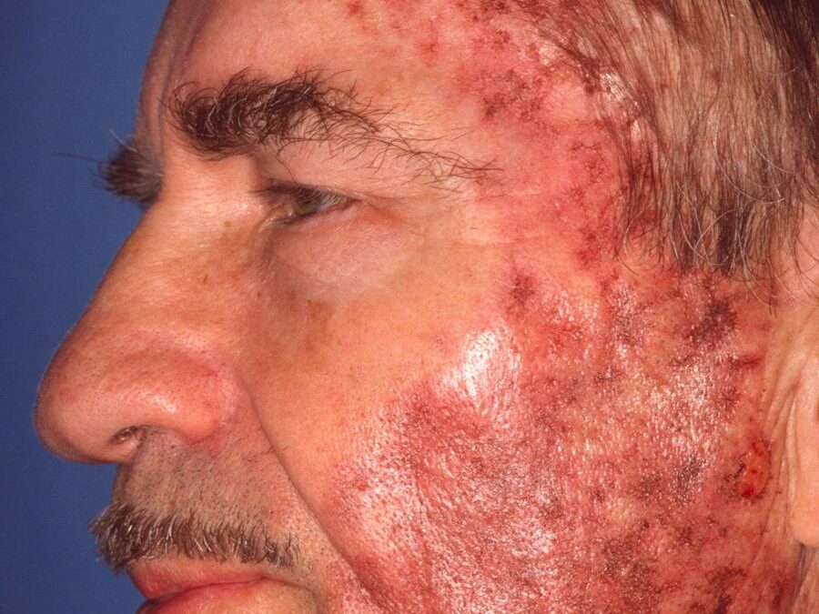 Actinic Keratosis:  Field Treatments—5-Fluorouracil, Imiquimod, Ingenol and Photodynamic Therapy (PDT)