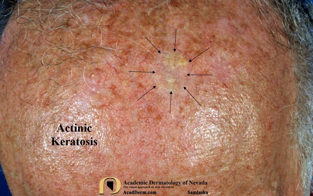 Actinic Keratosis:  Treatment—Cryotherapy