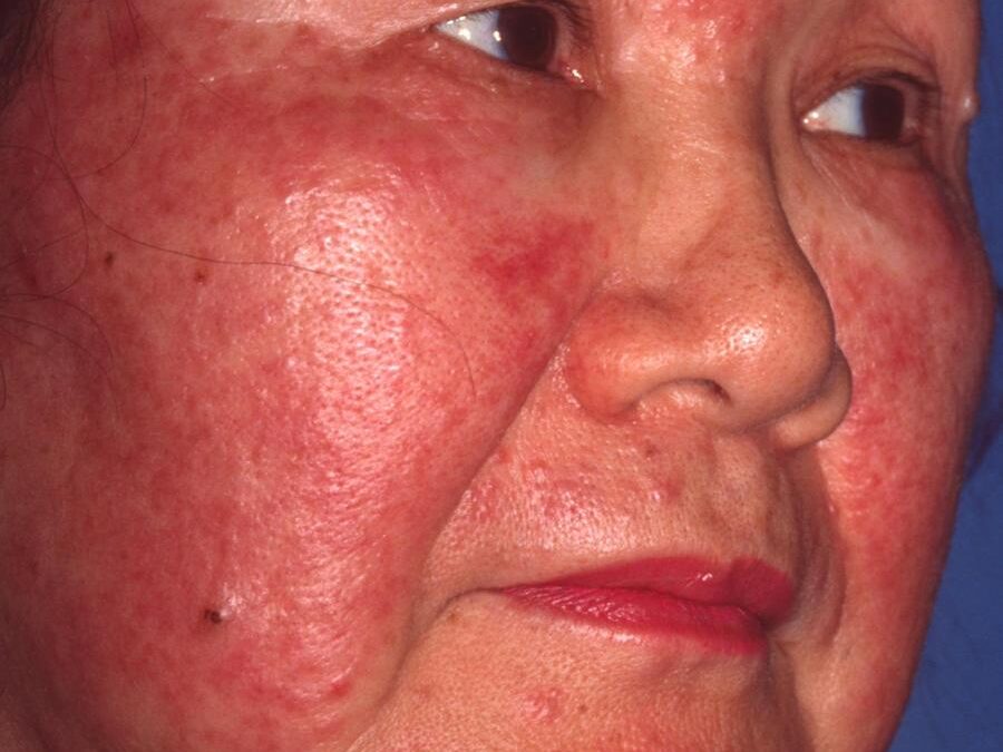 Acne Rosacea