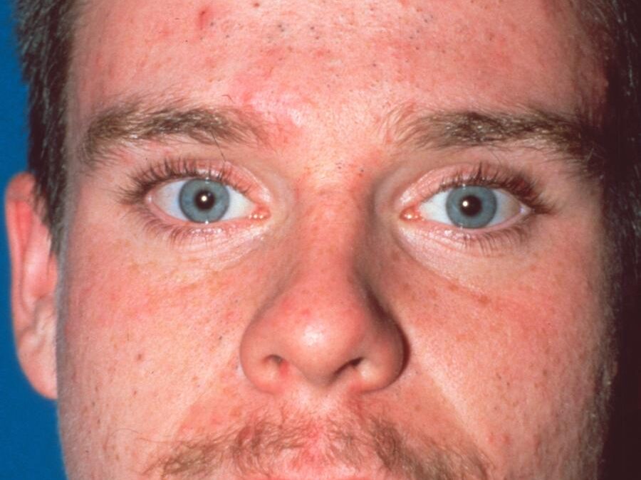 Acne Vulgaris:  The Good, the Bad and the Scarring…