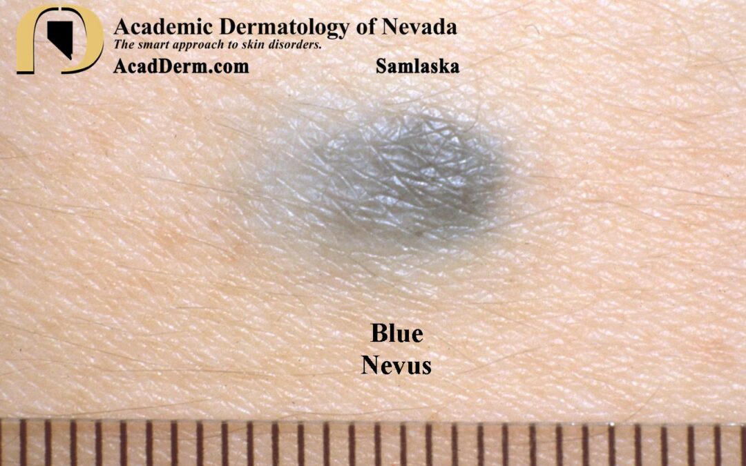 Blue Nevus