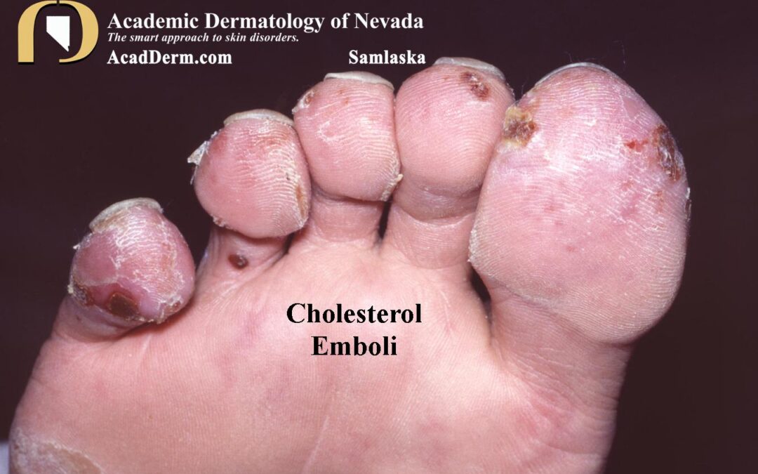 Cholesterol Emboli