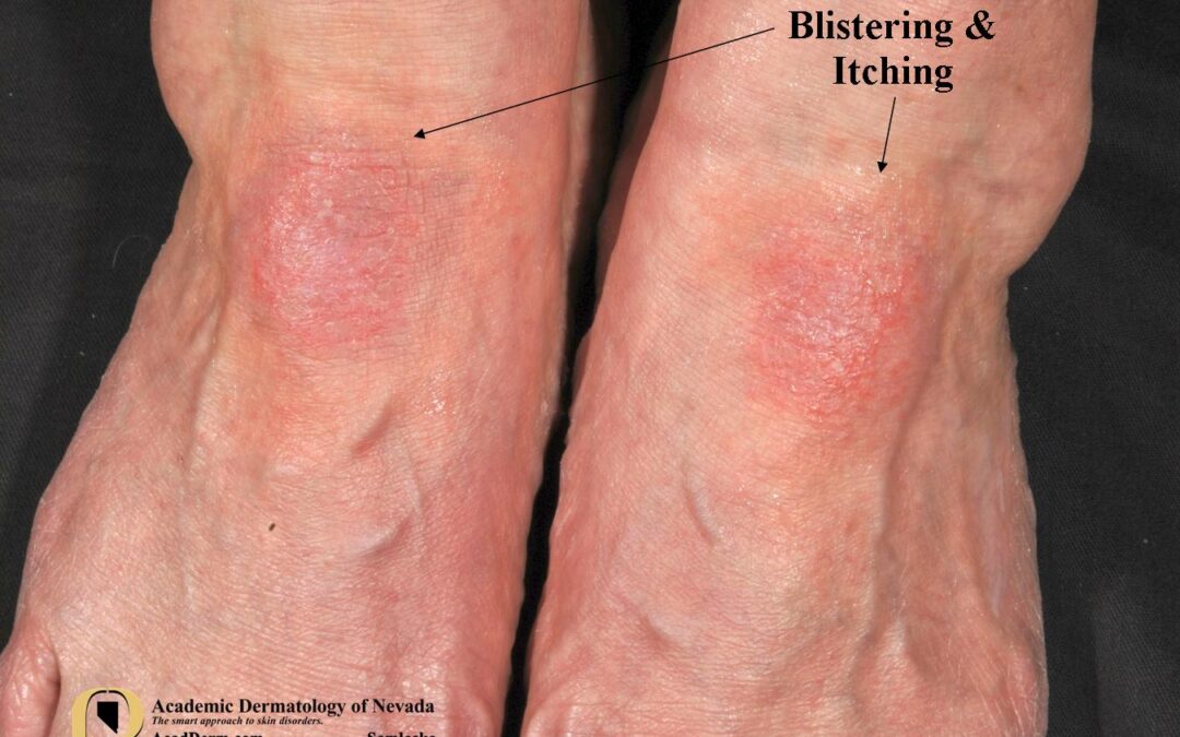 Dermatology Detective…Contact Dermatitis