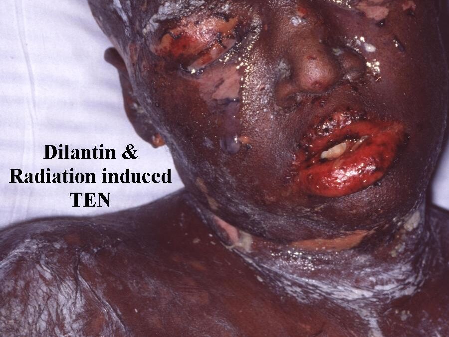Drug Eruptions:  Dilantin & Radiation Associated TEN