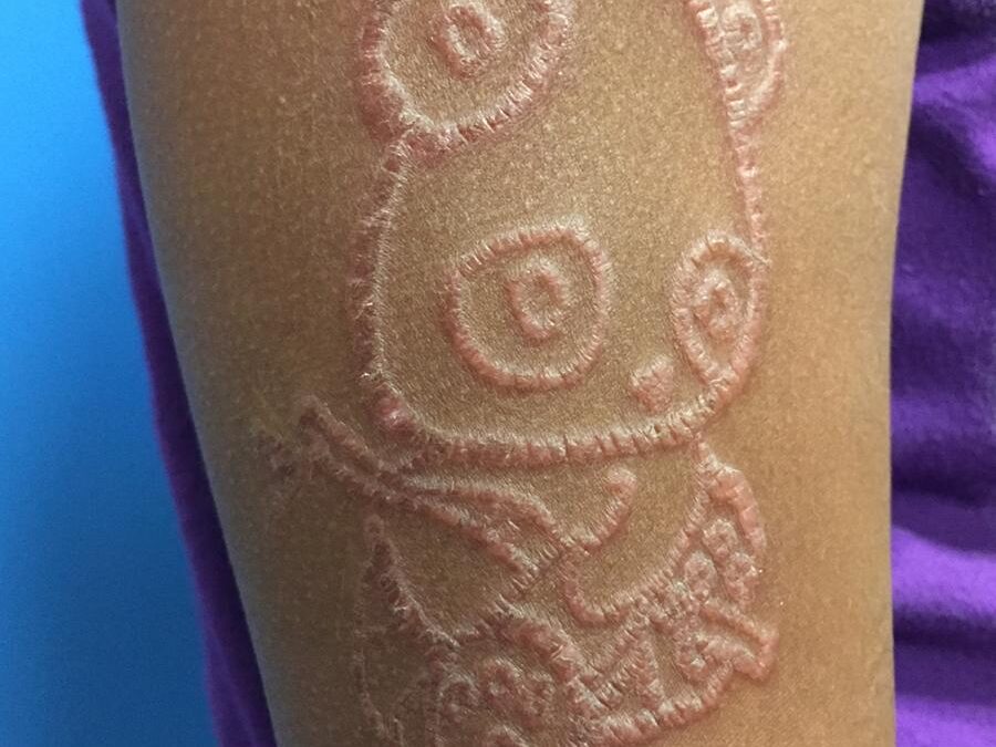 Contact Dermatitis:  Henna Tattoos