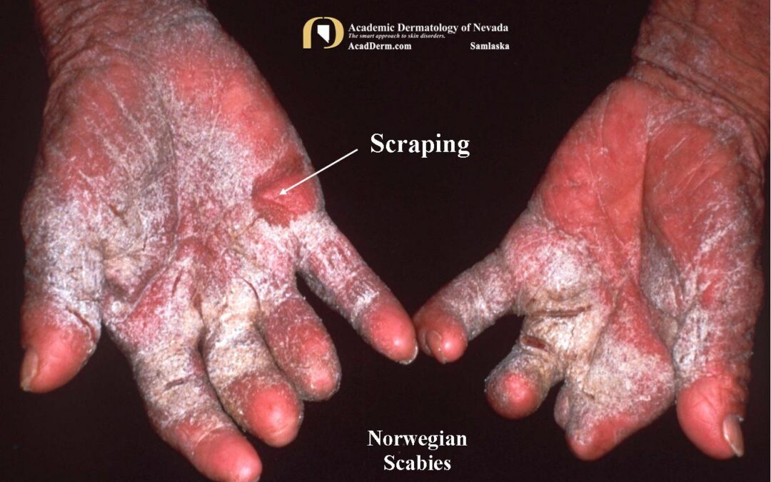 Parasitic Diseases:  Norwegian Scabies…a closer look…