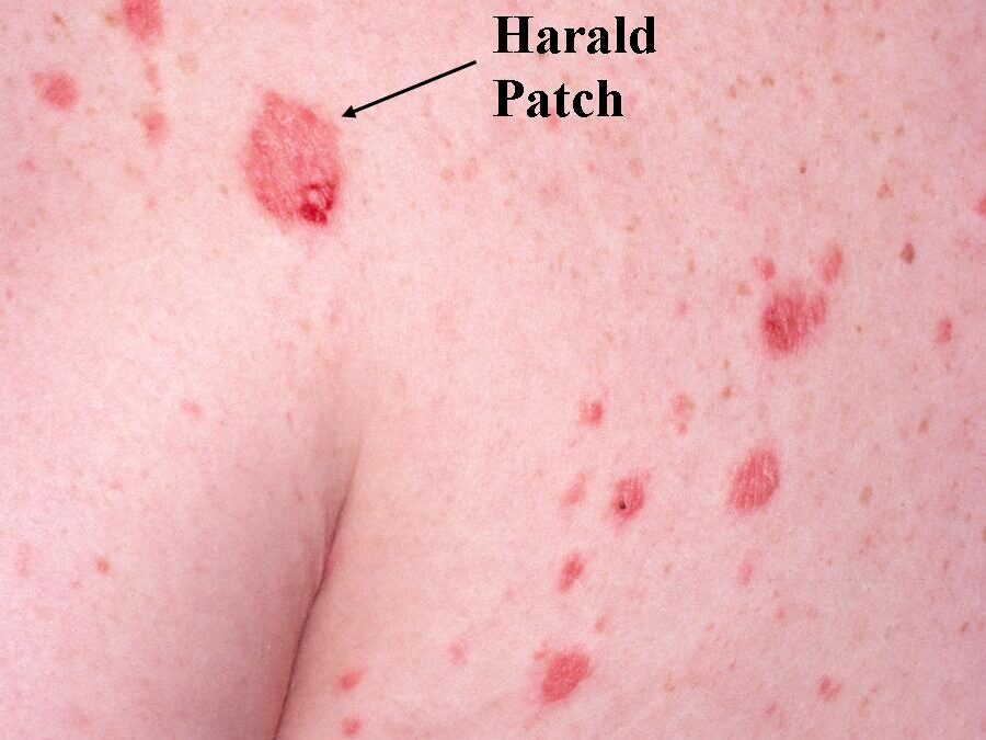Pityriasis Rosea–It starts with a Herald Patch…