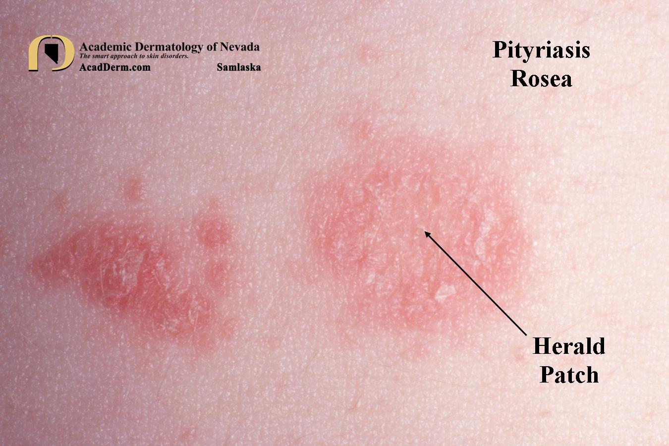 Rosa Rash Pityriasis Rosea–It starts with a Herald Patch… - Academic Dermatology ...