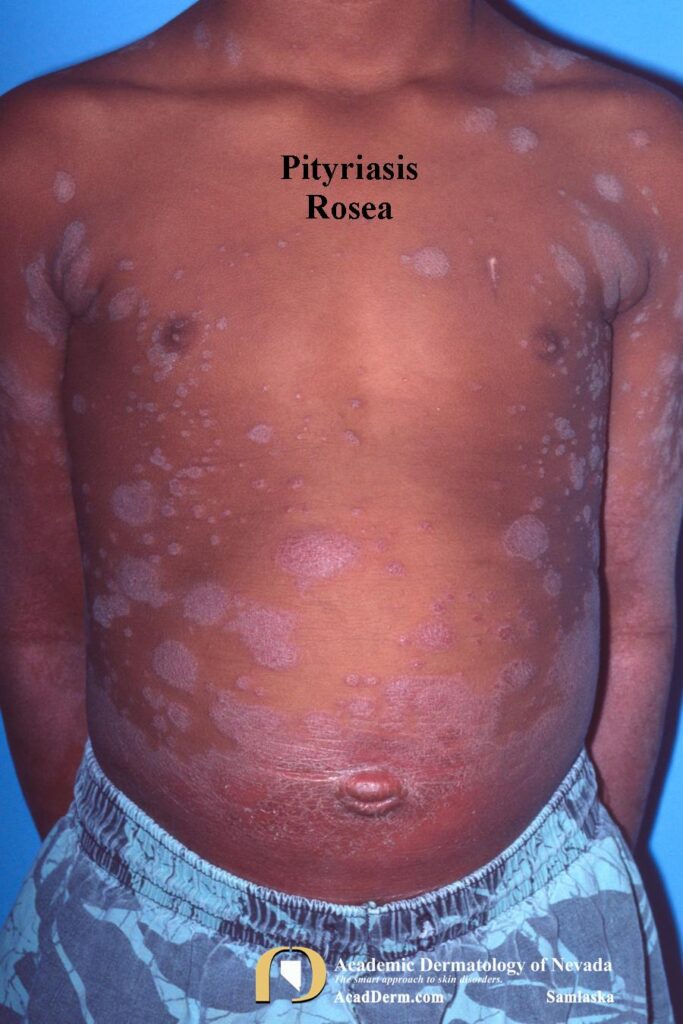 Pityriasis Rosea–It starts with a Herald Patch… - Academic Dermatology ...