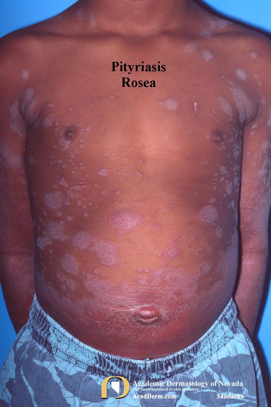 Ovoid Rash Pityriasis Rosea–It starts with a Herald Patch… - Academic Dermatology ...