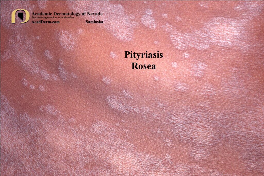 Ovoid Rash Pityriasis Rosea–It starts with a Herald Patch… - Academic Dermatology ...