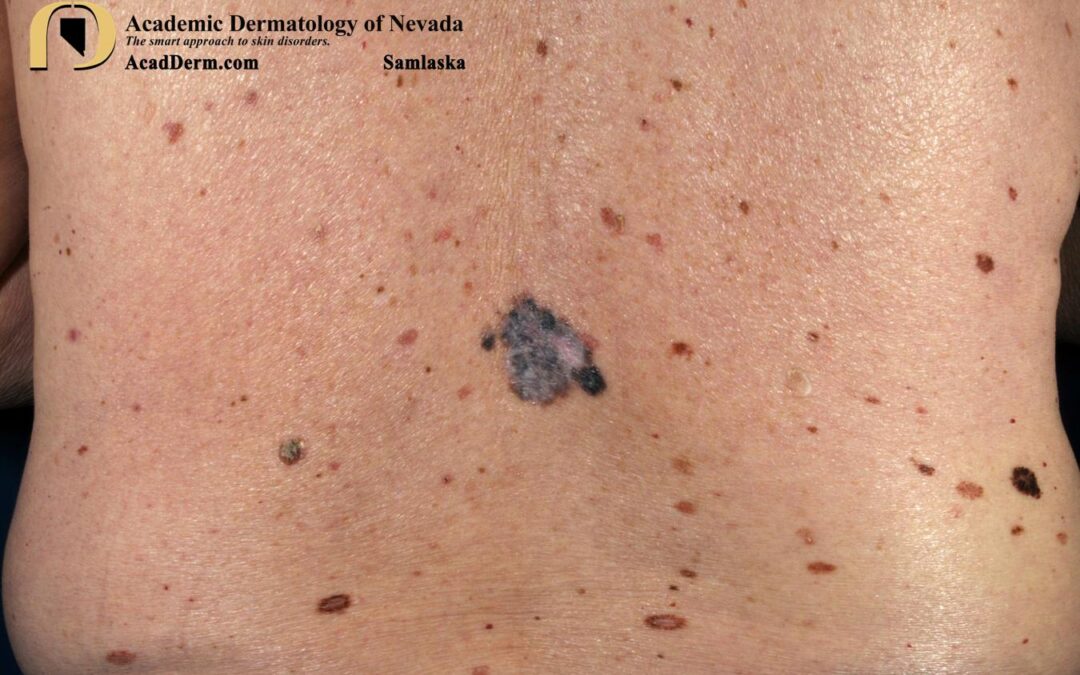 Regressive Melanoma