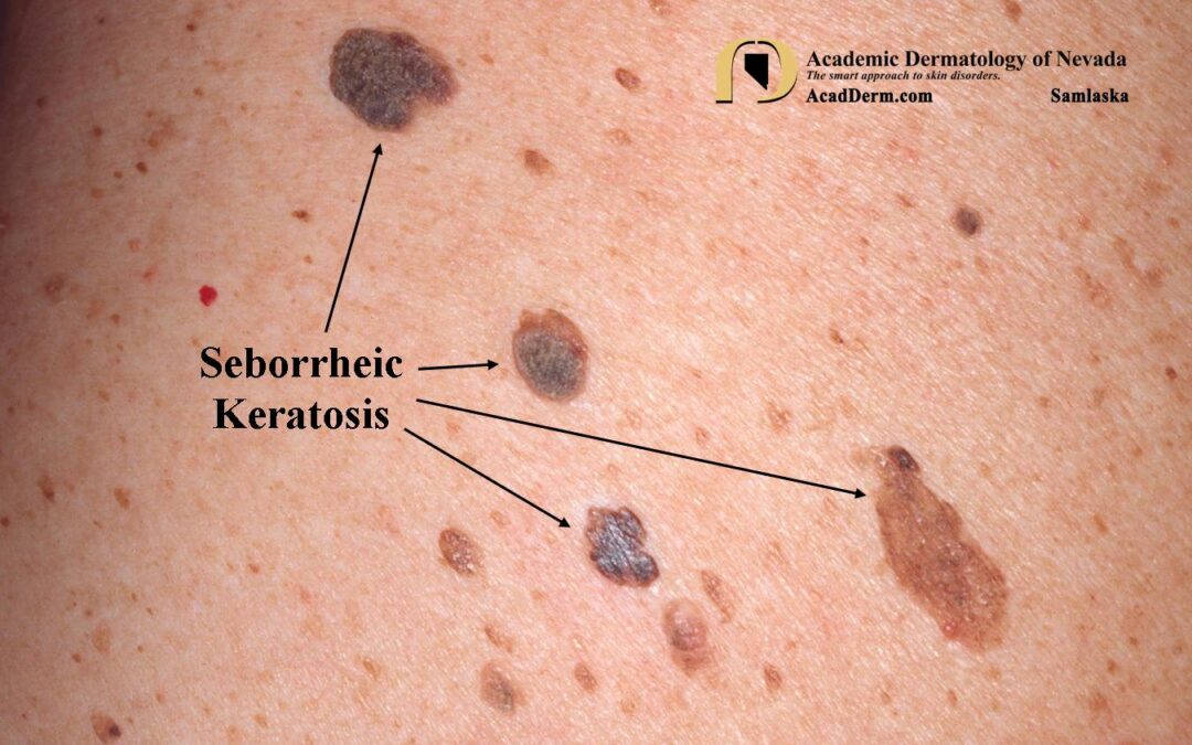 Seborrheic Keratosis:  Barnacles of life…