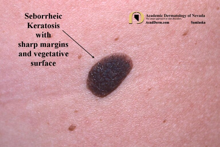 Seborrheic Keratosis: Barnacles of life… - Academic Dermatology of Nevada