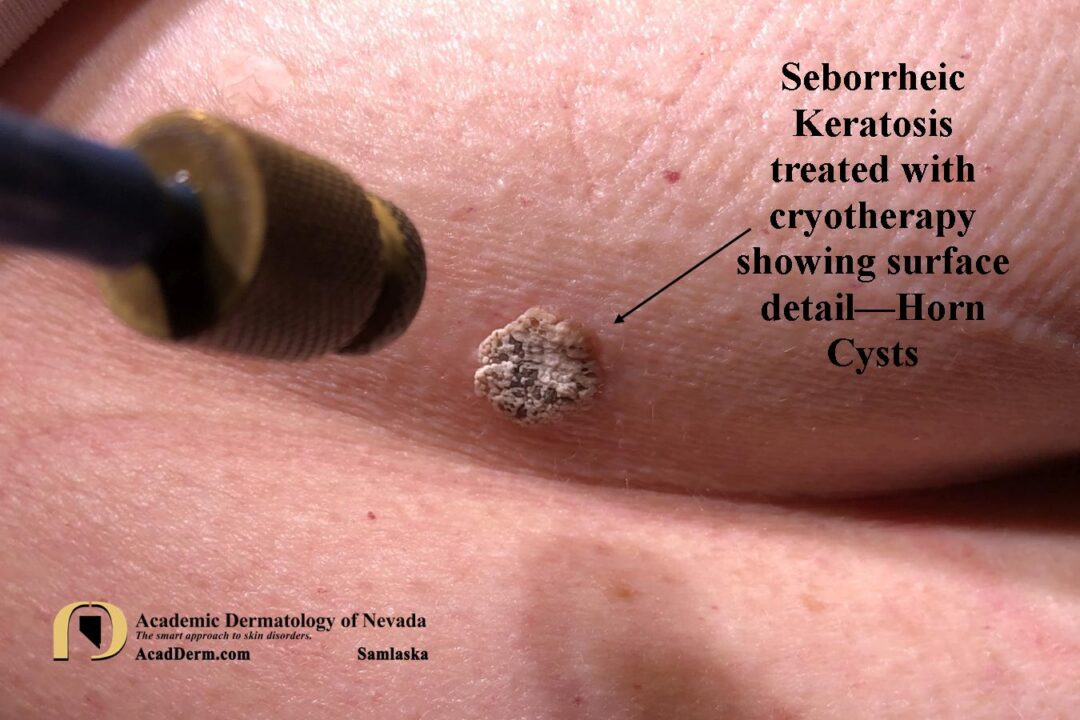 Seborrheic Keratosis: Barnacles of life… - Academic Dermatology of Nevada