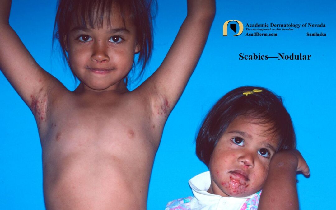 Parasitic Diseases:  Scabies