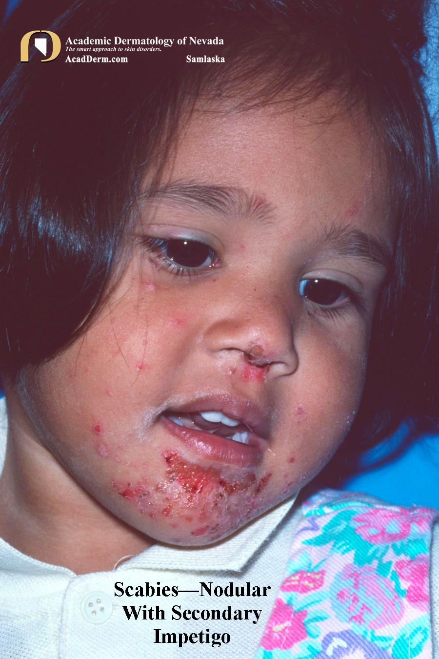 Parasite Rashes Parasitic Diseases: Scabies - Academic Dermatology of Nevada