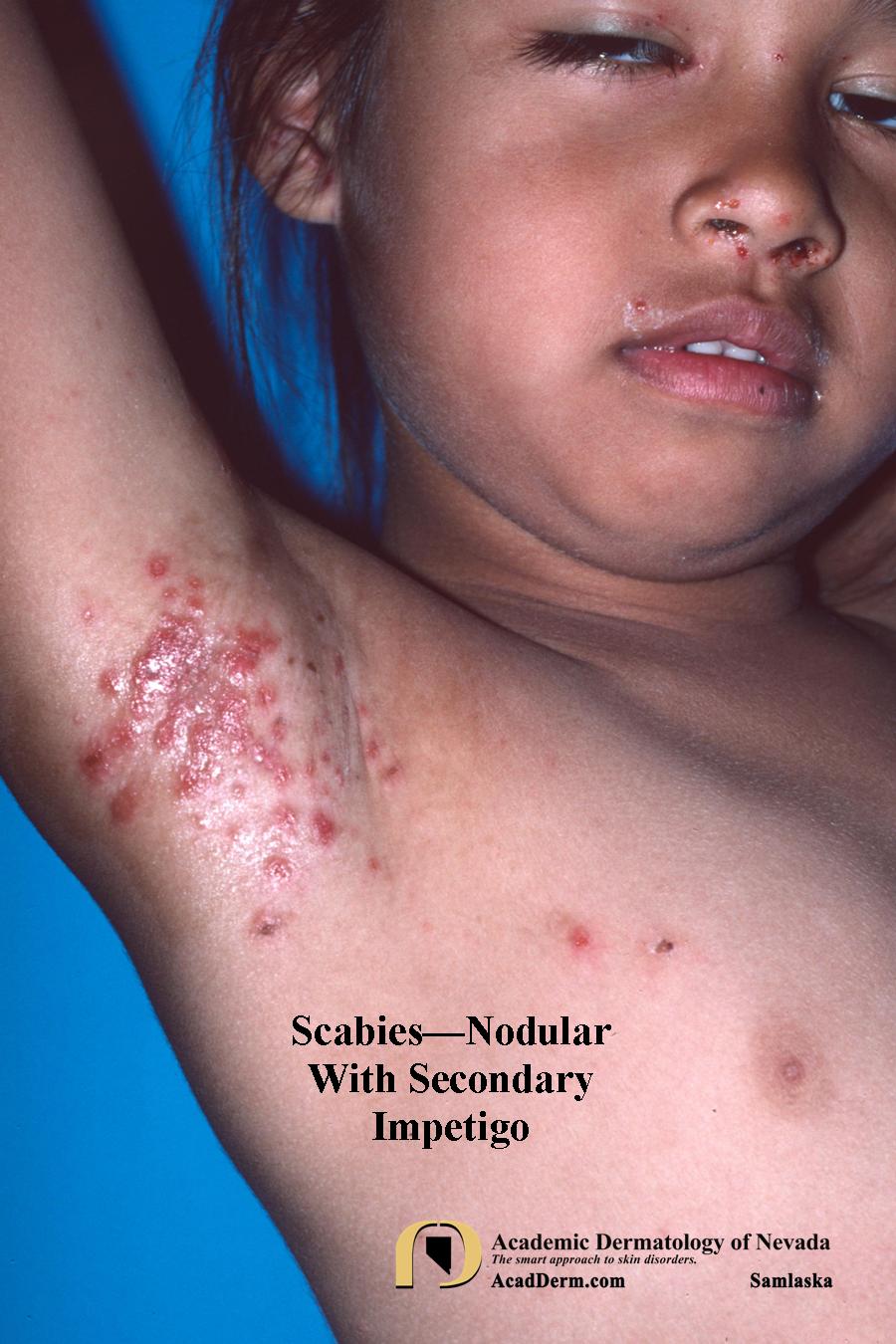 Parasitic Skin Rashes Parasitic Diseases: Scabies - Academic Dermatology of Nevada
