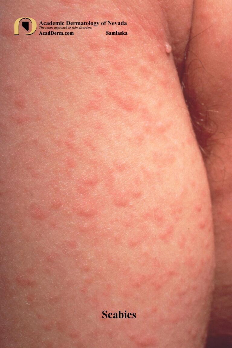 Parasitic Skin Rashes Parasitic Diseases: Scabies - Academic Dermatology of Nevada