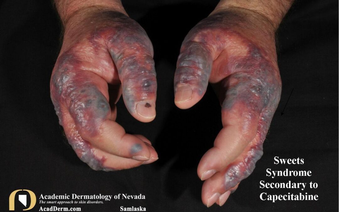 Drug Eruptions:  Capecitabine induced Sweet’s Syndrome