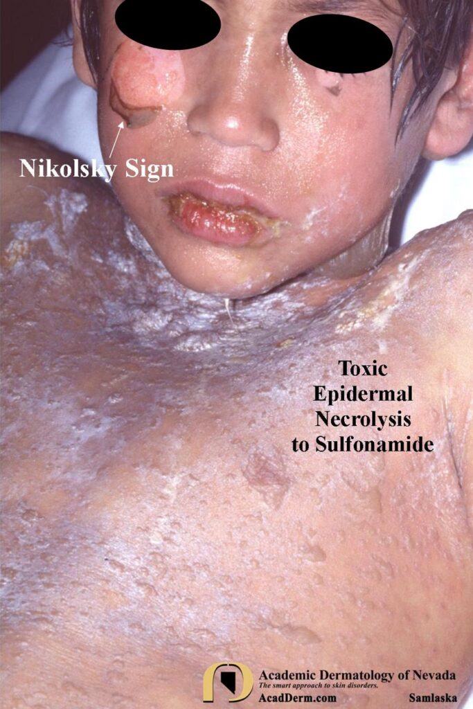 TENSamlaska - Academic Dermatology of Nevada