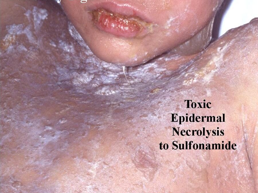 Drug Eruptions:  Toxic Epidermal Necrolysis (TEN)