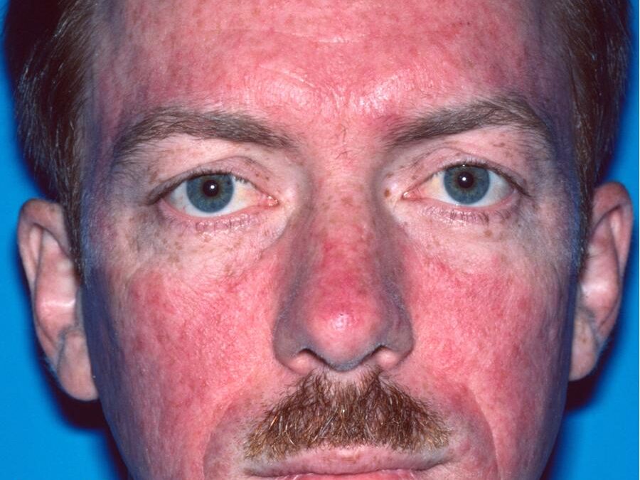Acne Medicamentosa:  A Side Effect of Medicines