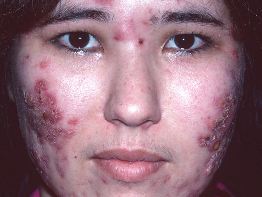 Complex Acne Disorders:  Pyoderma Faciale…