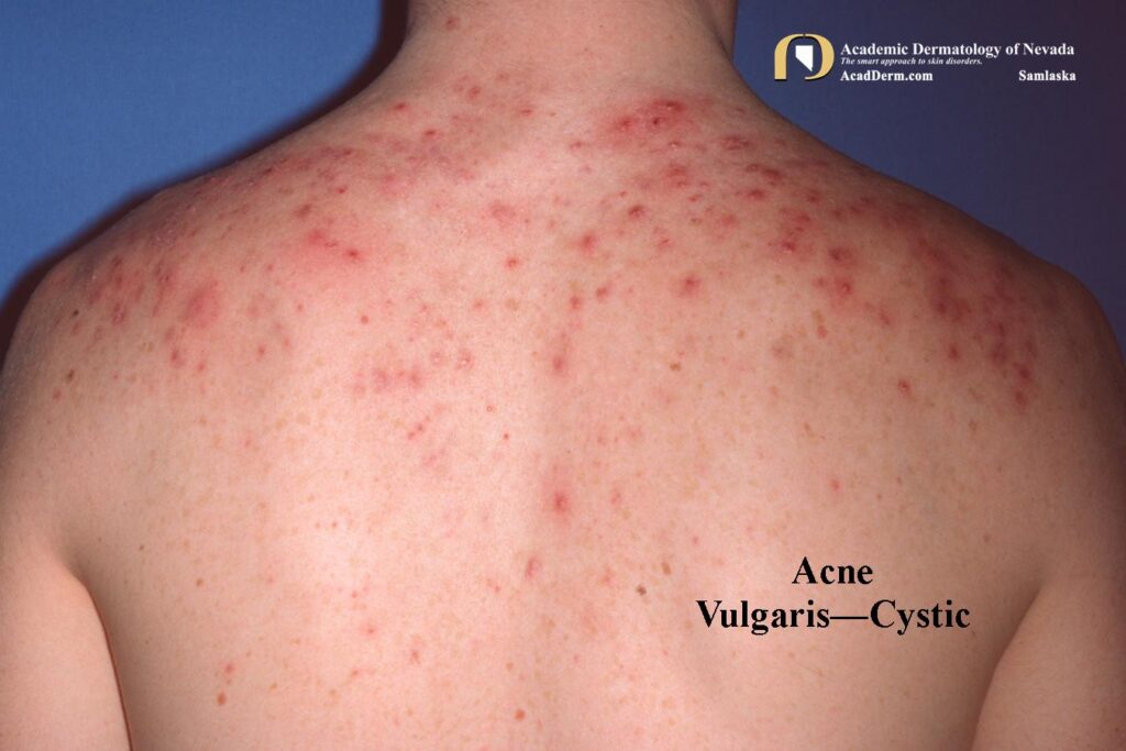 AcneVulgaris8Samlaskajpg - Academic Dermatology of Nevada