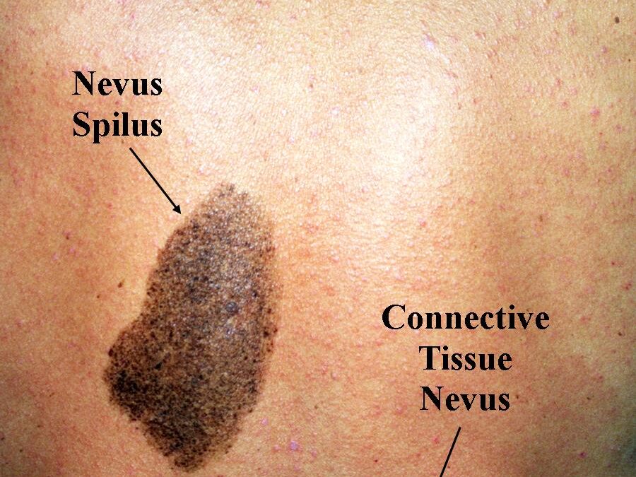Nevus Spilus:  Speckled Lentiginous Nevus…