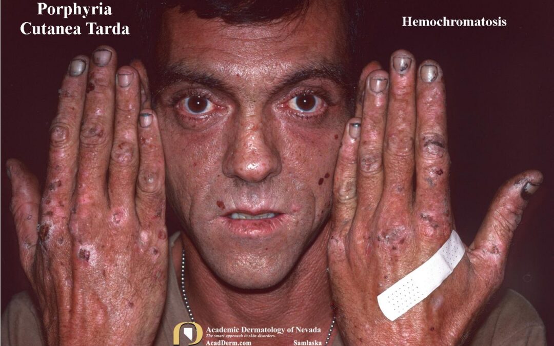 Porphyria Cutanea Tarda (PCT):  A Photosensitive Disorder…