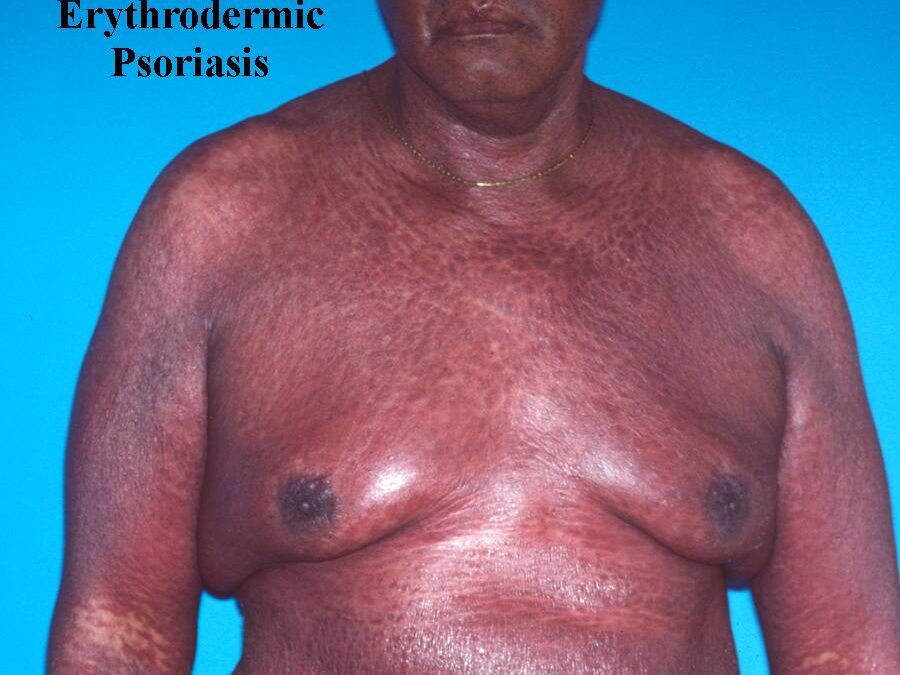 Erythrodermic Psoriasis:  An Exfoliative Dermatitis…
