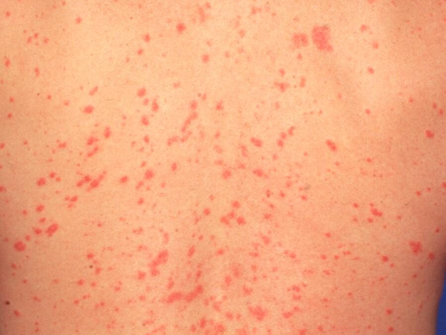 Guttate Psoriasis:  A Shower of Scaly Teardrops…