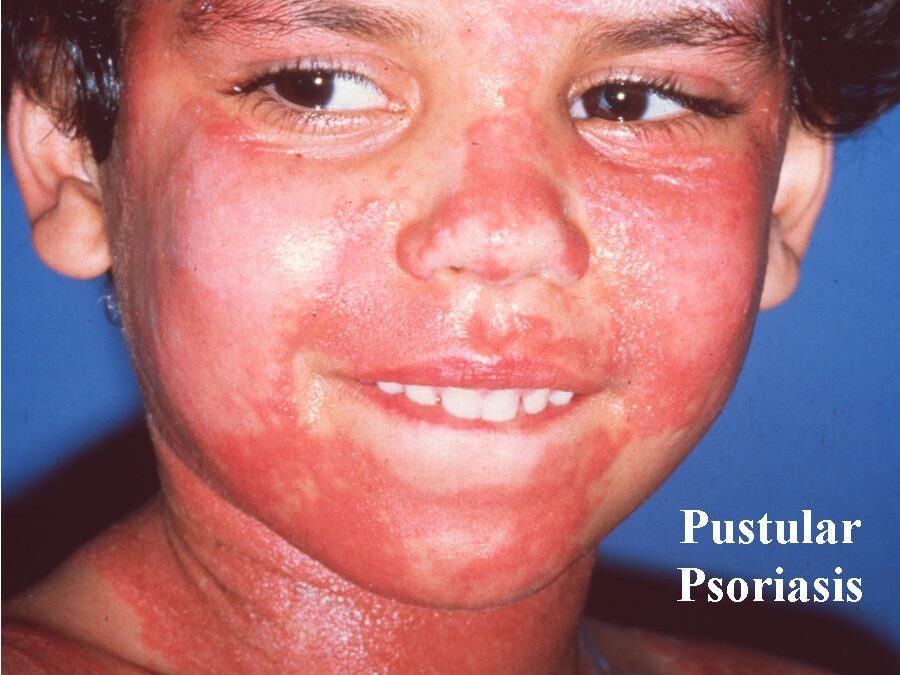 Pustular Psoriasis:  Lakes of Sterile Pustules…