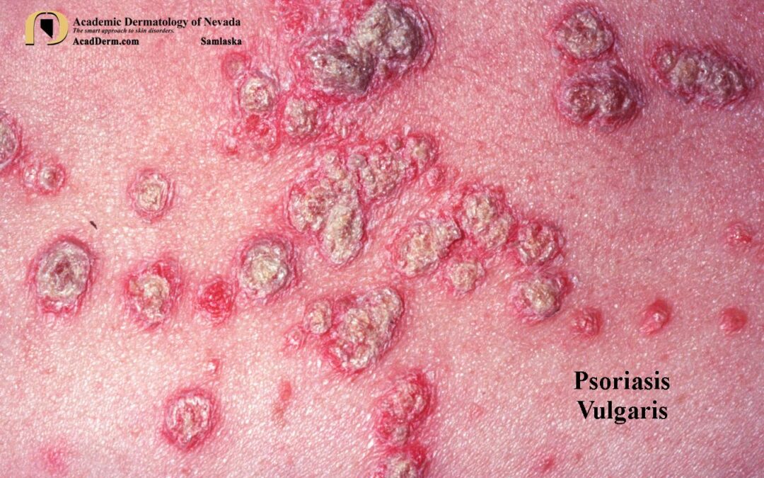 Psoriasis Vulgaris:  The Basics…