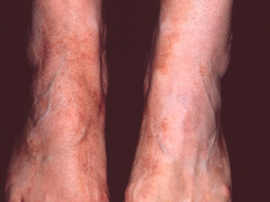 Schamberg’s Disease:  A Pigmentary Purpuric Eruption…