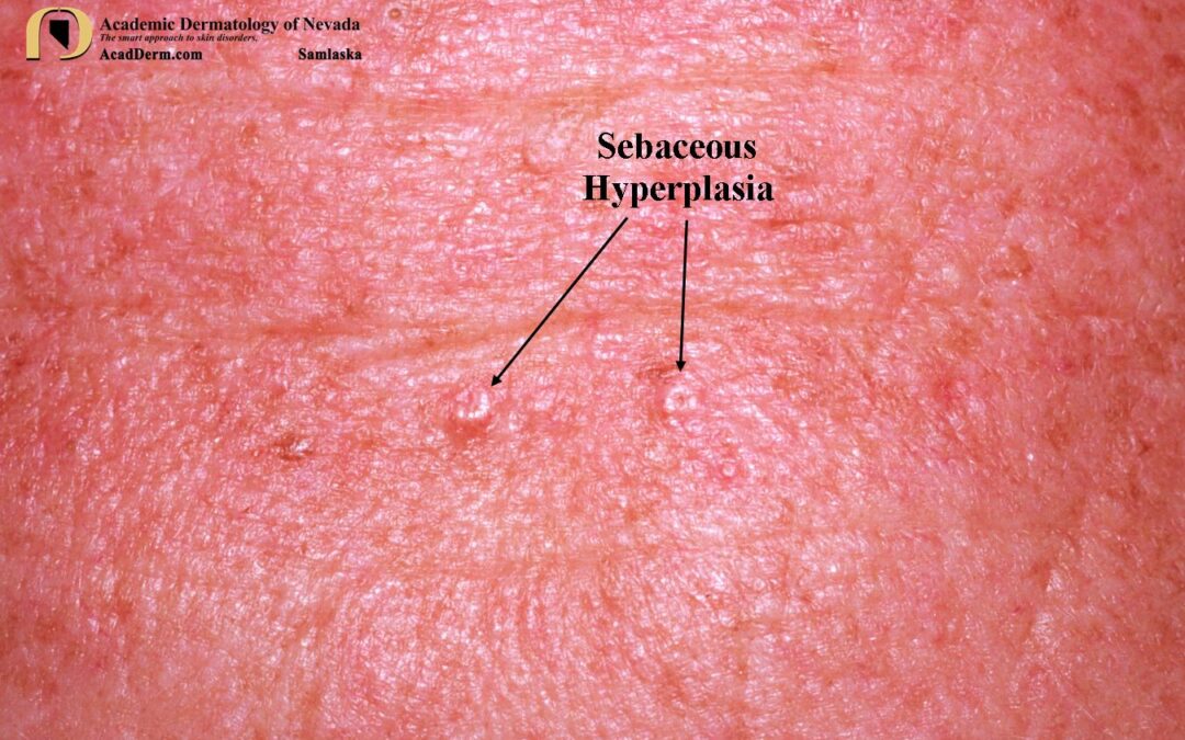 Sebaceous Hyperplasia:  Tiny Yellow Donuts…