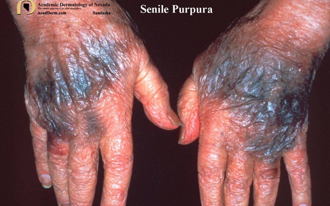 Senile Purpura:  Bruising In The Elderly…