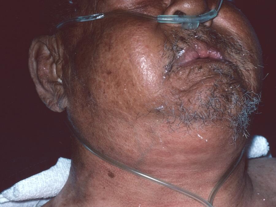 Subcutaneous Emphysema:  It’s a gas…gas…gas…