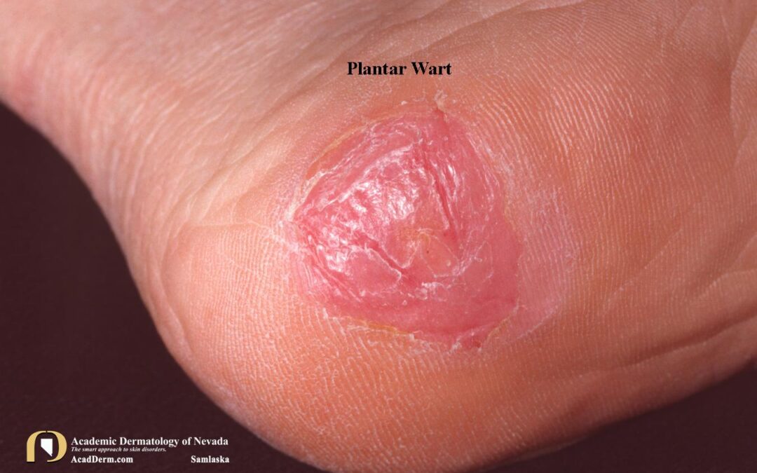 Plantar Warts (Verruca Plantaris):  Seed Warts?