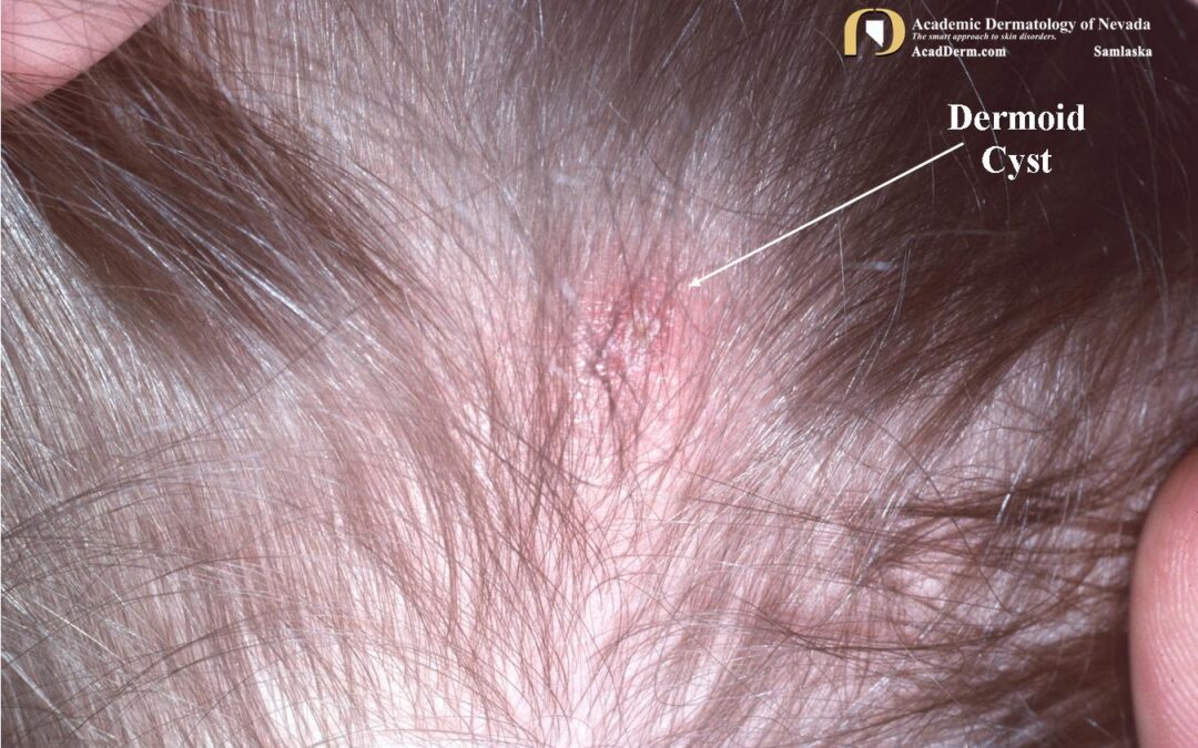 Dermoid Cysts:  Once Upon A Time…