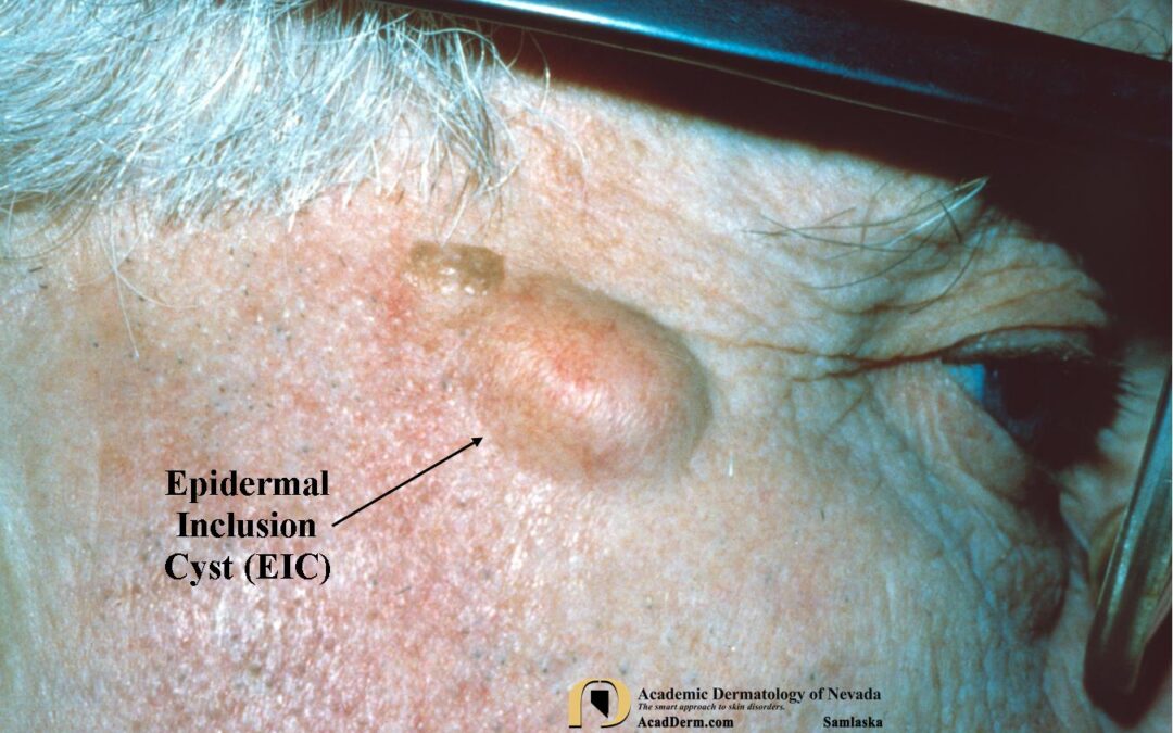 Epidermal Inclusion Cysts (EIC):  Epidermoid Cysts…