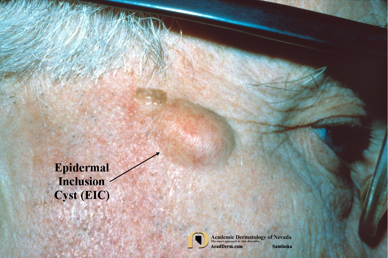 Epidermal Infundibular Cysts Dermatology Advisor