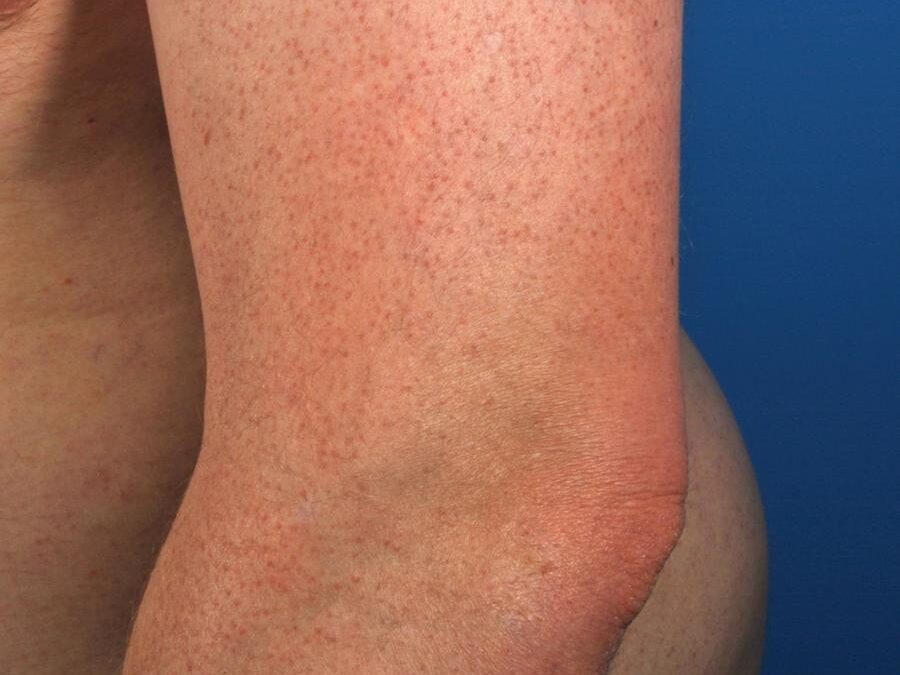 Keratosis Pilaris: It Feels Like Sandpaper…