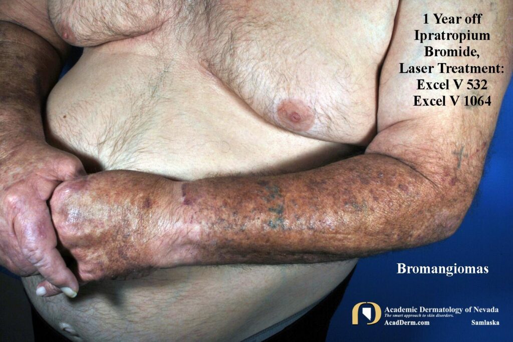 BromangiomaFU3aSamlaska - Academic Dermatology of Nevada