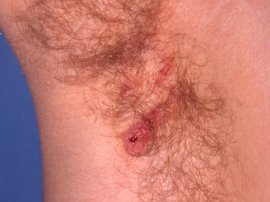 Hidradenitis Suppurativa:  Acne Inversa, Velpeau’s Disease…