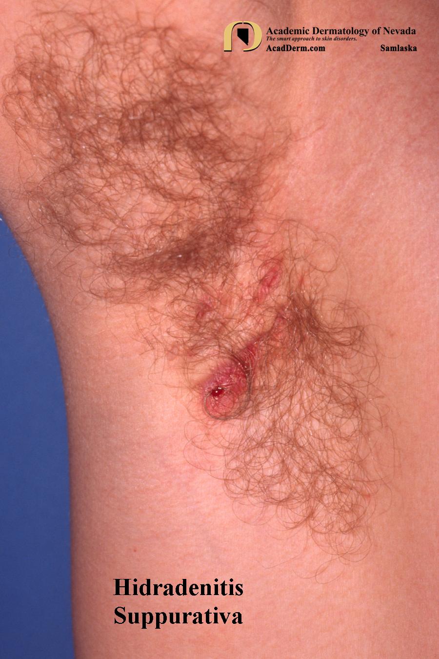 Hidradenitis Suppurativa: Acne Inversa, Velpeau's Disease - Academic  Dermatology of Nevada